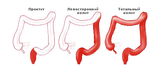 Колит кишечника: симптомы, лечение у взрослых1