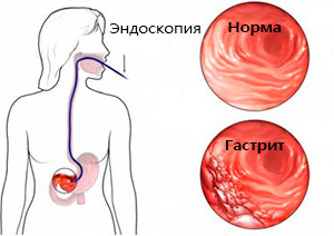 Гастрит: симптомы, виды, лечение поверхностного гастрита1