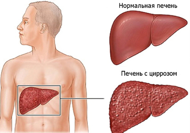 Цирроз печени: симптомы, лечение, стадии1
