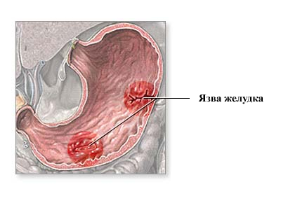 Язва желудка: симптомы, лечение, народные средства1