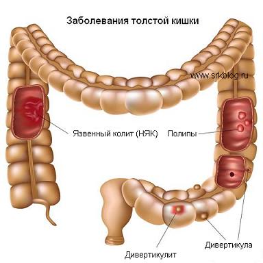 Язвенный колит: симптомы, лечение: болезнь и диета1