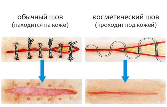 Лигатурный свищ после операции: лечение, операция, мкб, фото