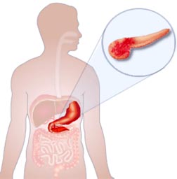 Заболевания поджелудочной железы: симптомы, диагностика1