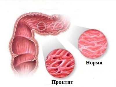 Проктит прямой кишки: симптомы, лечение, фото, отзывы1