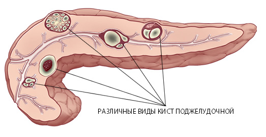 Киста поджелудочной железы: симптомы, лечение, операция, фото1