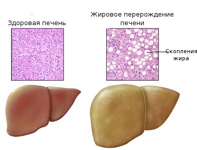 Жировой гепатоз печени: симптомы, лечение1