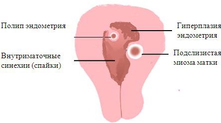 Гиперплазия эндометрия: симптомы, лечение, отзывы, фото1