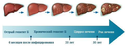 Хронический гепатит: симптомы, лечение, форма1