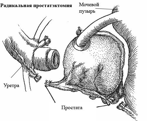 Радикальная простатэктомия послеоперационный период: прогноз1
