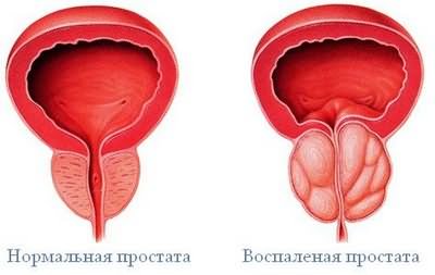 Гонорейный простатит: симптомы, лечение, фото1