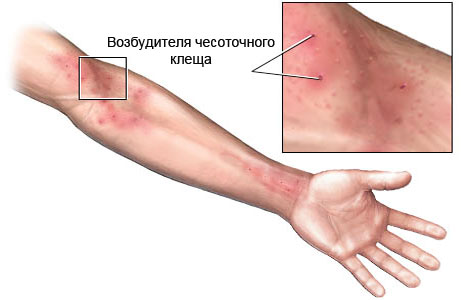 Чесотка: симптомы, первые признаки, лечение1