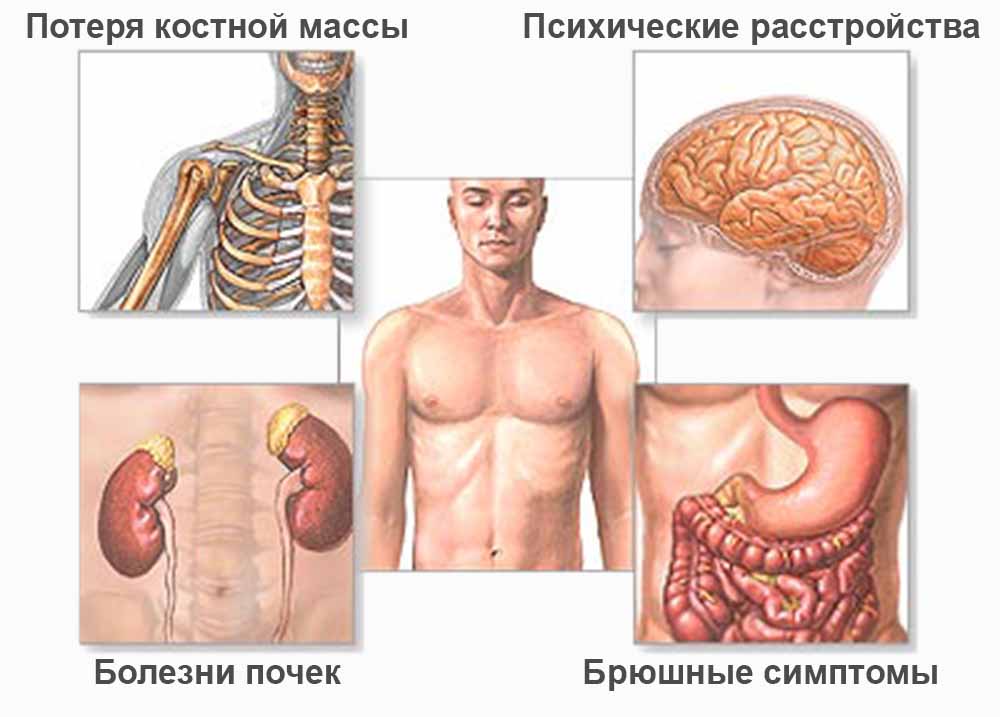 Гиперпаратиреоз у детей: причины, последствия, лечение, препараты1
