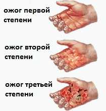 Ожог, обморожение, рожа у детей: первая помощь, лечение1