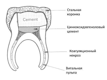 Пульпотомия. Методика пульпотомии молочных зубов1