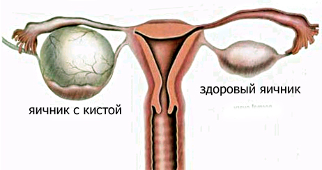 Киста яичника: симптомы, лечение, операция1