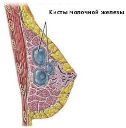 Киста молочной железы: причины, диагностика, лечение1