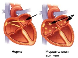 Последствия мерцательной аритмии: рекомендации врачей, лечение1