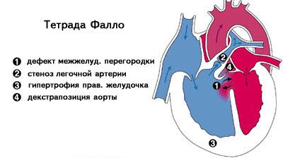Тетрада Фалло: описание, диагностика, методы лечения, рекомендации врачей1
