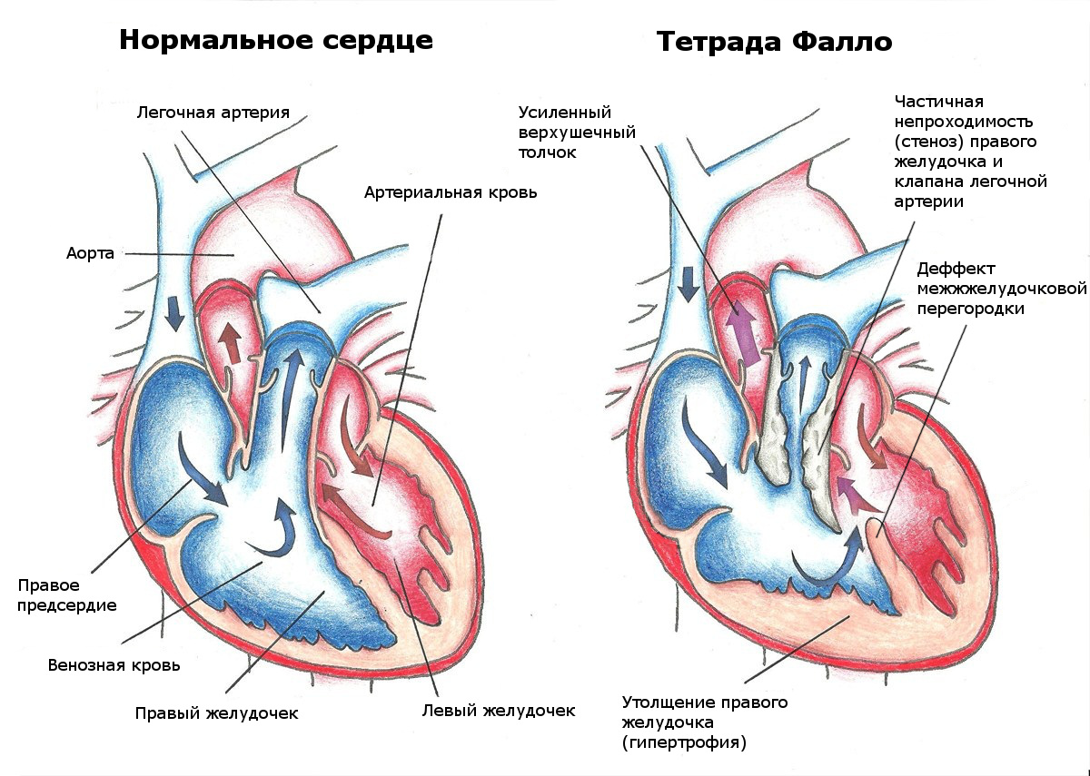 Лечение тетрады Фалло: способы, этапы, рекомендации врачей1