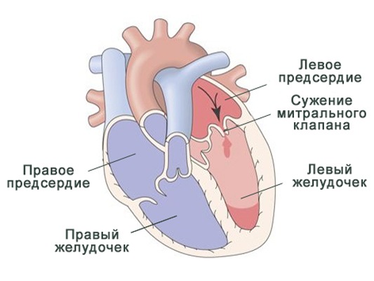 Врожденная недостаточность митрального клапана1