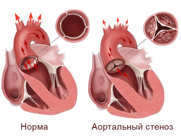 Клапанный стеноз аорты: диагностика, лечение, рекомендации врачей1