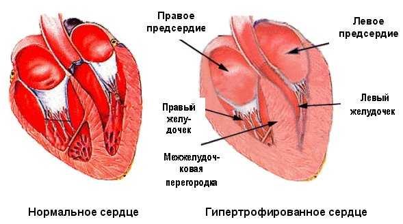 Подклапанный стеноз аорты: диагностика, лечение, рекомендации врачей1