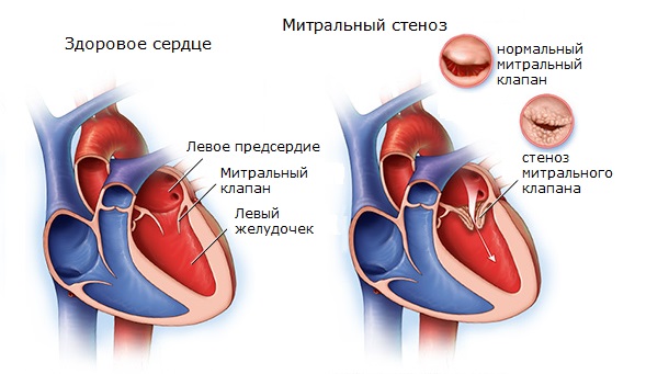 Митральный стеноз: симптомы, диагностика, лечение, последствия1