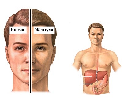 Механическая желтуха: причины, симптомы, лечение