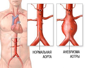Аневризма аорты брюшной полости: операция, симптомы, лечение1