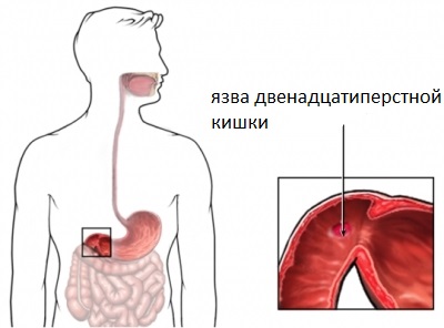 Язва двенадцатиперстной кишки: симптомы, лечение, диета, фото1