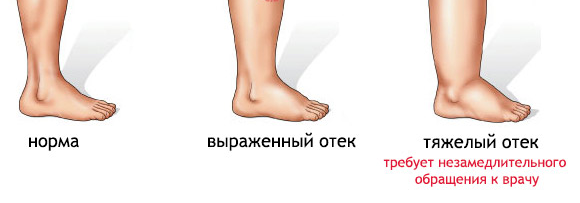 Почему отекают ноги: причины, лечение, при беременности, фото, видео