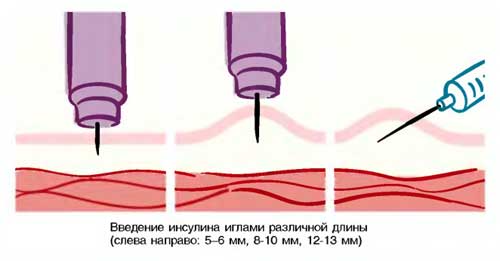 Сахарный диабет 1 типа у детей: этиология, лечение, профилактика22