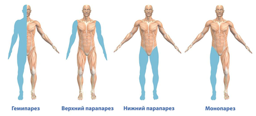 Коарктация аорты: операция, этапы, последствия22