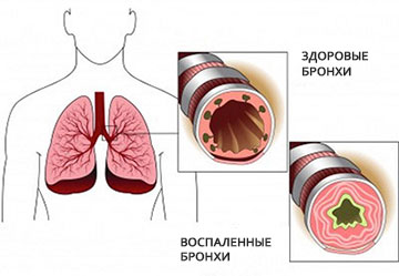 Пылевой бронхит: симптомы и лечение22