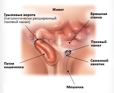 Паховая грыжа у женщин: симптомы, лечение, операция, фото2