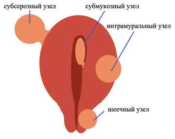 Миома матки: симптомы, лечение, операция2