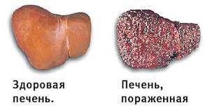 Болит печень, что делать?2