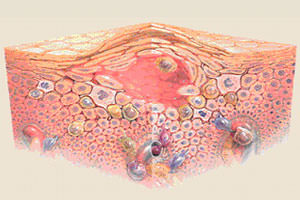 Экзема начальная стадия: лечение, фото, на руках и ногах2