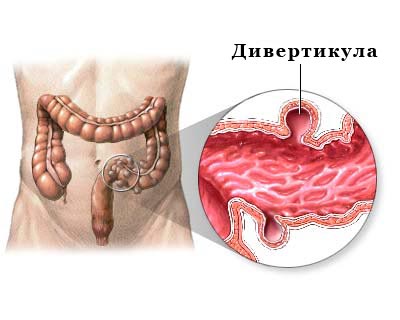 Дивертикулез кишечника: симптомы, осложнения, лечение2