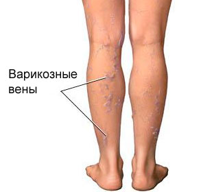 Болят вены, что делать?2