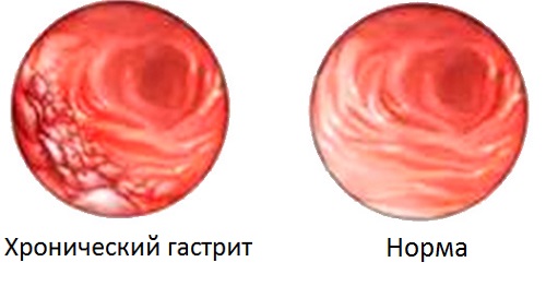 Гастрит: симптомы, виды, лечение поверхностного гастрита2