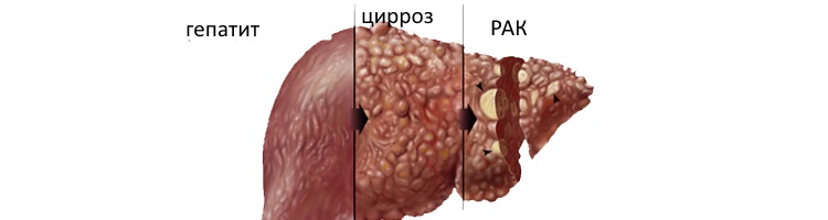 Рак печени: симптомы, лечение, сколько живут? 2