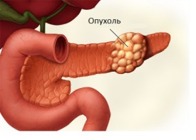 Рак поджелудочной железы: симптомы, проявления, лечение2