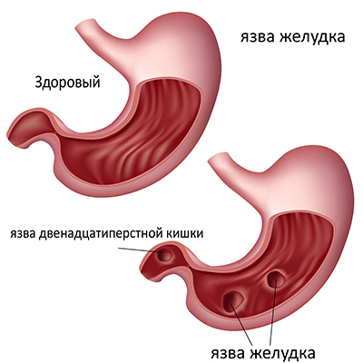 Язва желудка: симптомы, лечение, народные средства2