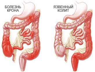 Язвенный колит: симптомы, лечение: болезнь и диета2