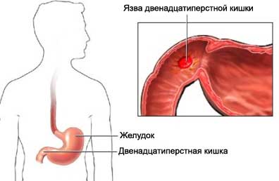 Язва двенадцатиперстной кишки: симптомы, лечение, диета, фото2