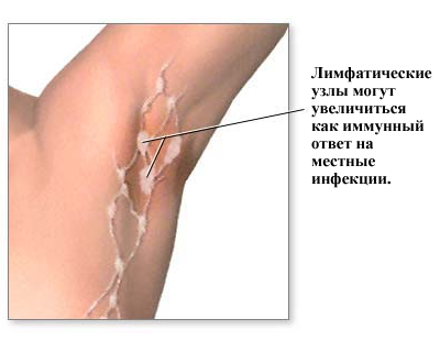 Что такое Лихорадка? Денге, Лаоса, Эбола, Желтая2