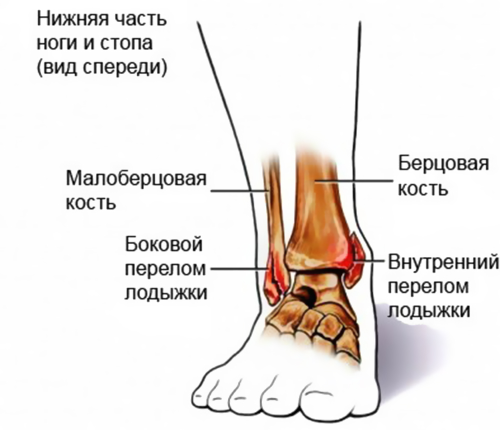 Перелом лодыжки: со смещением, без смещения, лечение, фото2