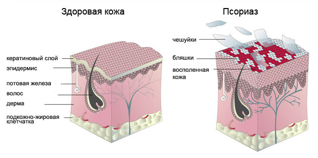 Псориаз: лечение в домашних условиях, фото, начальная стадия2