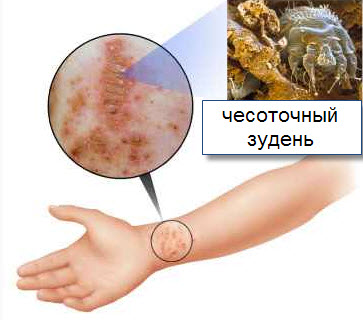 Чесотка: симптомы, первые признаки, лечение2